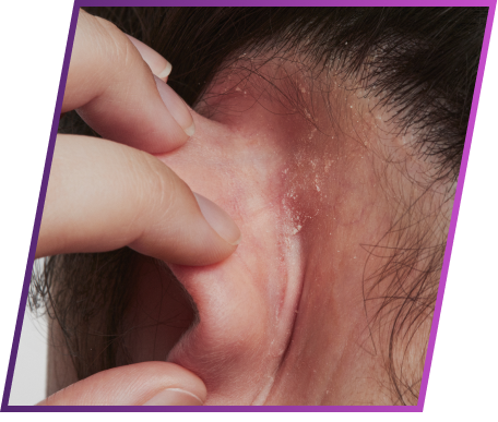 Image of irritatin symptom