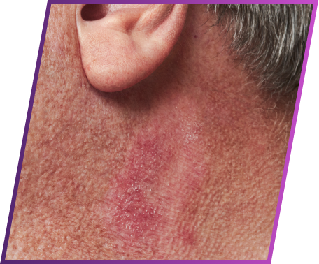 Image of redness symptom