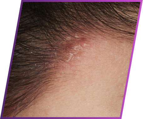 Image of scaling symptom